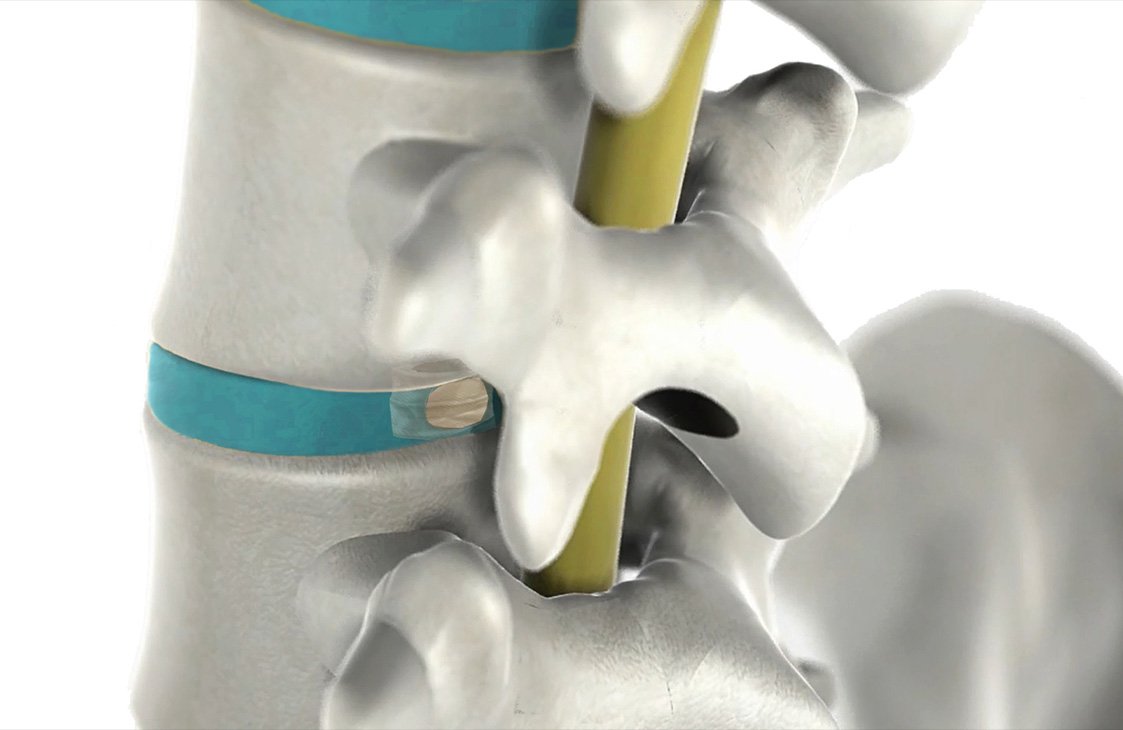 Ampliacio de capital a Neos Surgery per a la validació d’un nou paradigma en el tractament de l'hèrnia discal